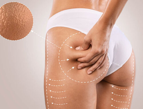 Les traitements contre la cellulite : comment s’en débarrasser ?